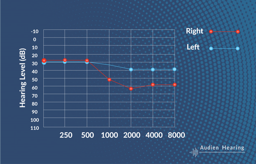 Asymmetrical Sensorineural Hearing Loss